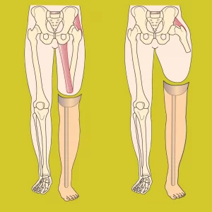 What is Multiple Extremity Amputations?