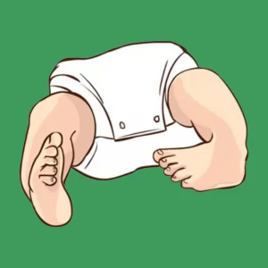 What is Arthrogryposis (AMC)