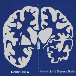Huntington’s Disease