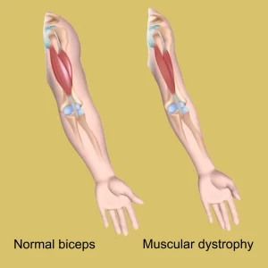 Progressive Muscular Atrophy (PMA)