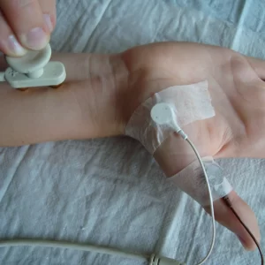 Help with neuromuscular diseases nerve conduction velocity