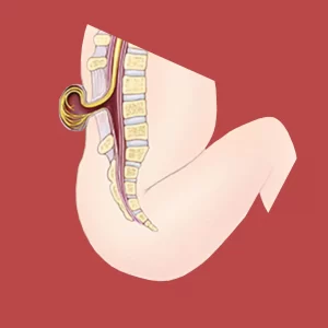 What is Spina Bifida (SB)?